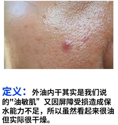 油痘肌和油敏肌怎么區(qū)分？油痘肌和油敏肌的區(qū)別！