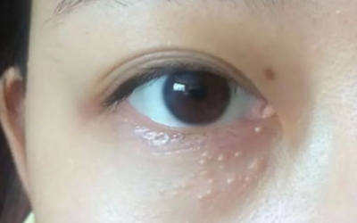為什么眼部容易長脂肪粒？