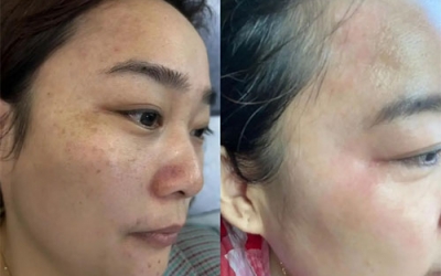 祛斑最好的土方法有哪些？